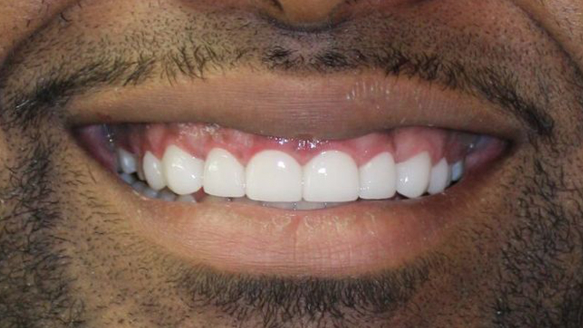 Before & After Photos Vicksburg, MS Nash Family Dentistry