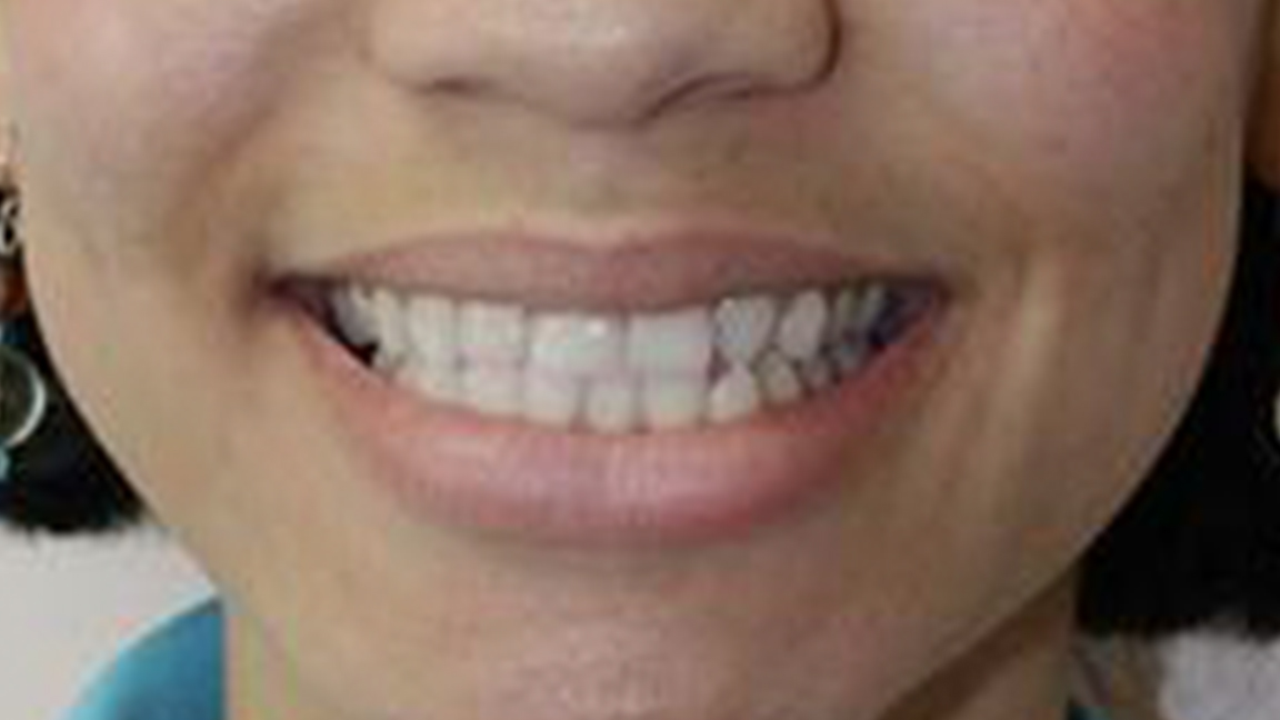 Before & After Photos Vicksburg, MS Nash Family Dentistry