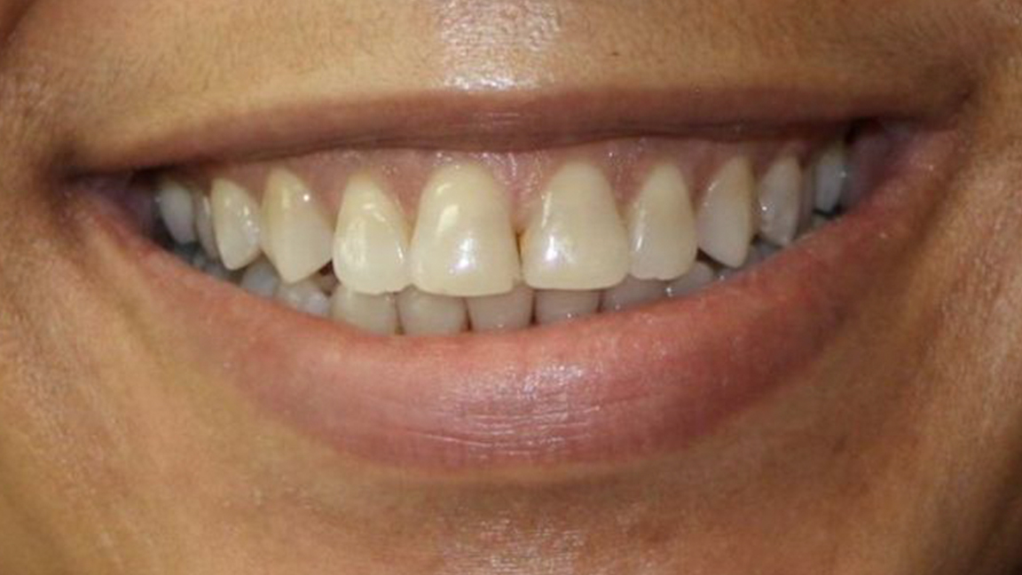 Permanent whitening before Image - Vicksburg, MS