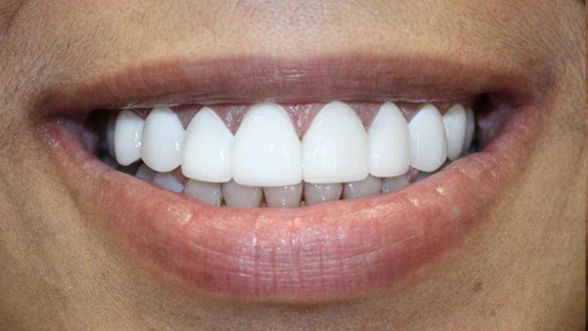Permanent whitening after Image