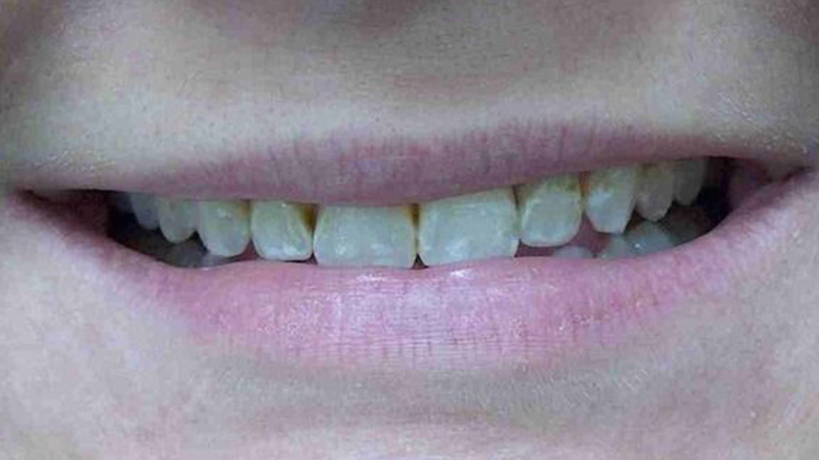 Permanent whitening before image - Vicksburg, MS