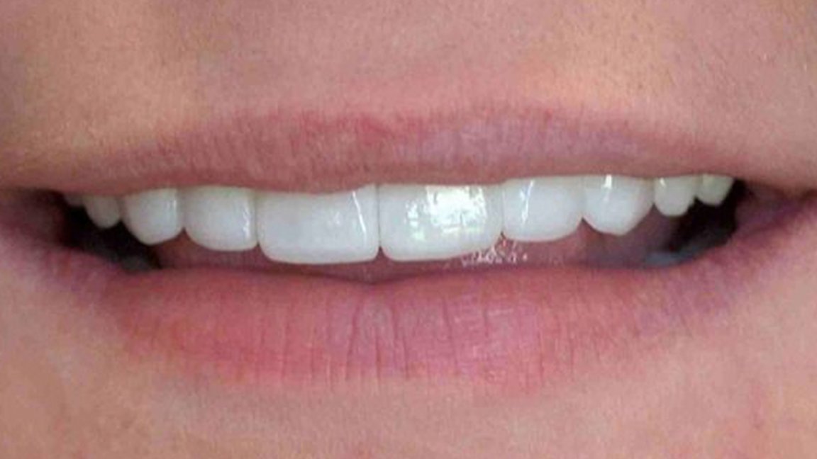 Permanent whitening after image - Vicksburg, MS