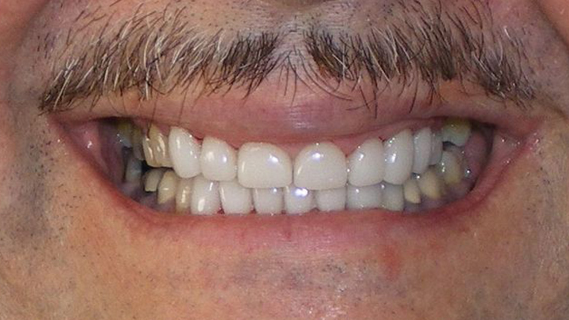 Dental Crowns after 2 - Vicksburg, MS