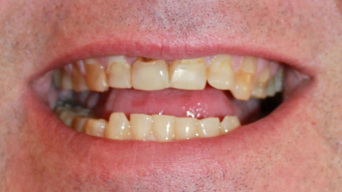 before and smile after photos at Nash Family Dentistry