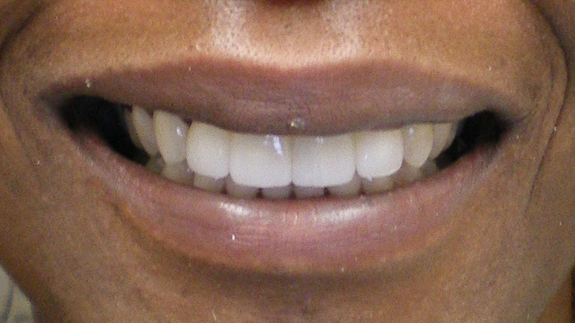 before and smile after photos at Nash Family Dentistry