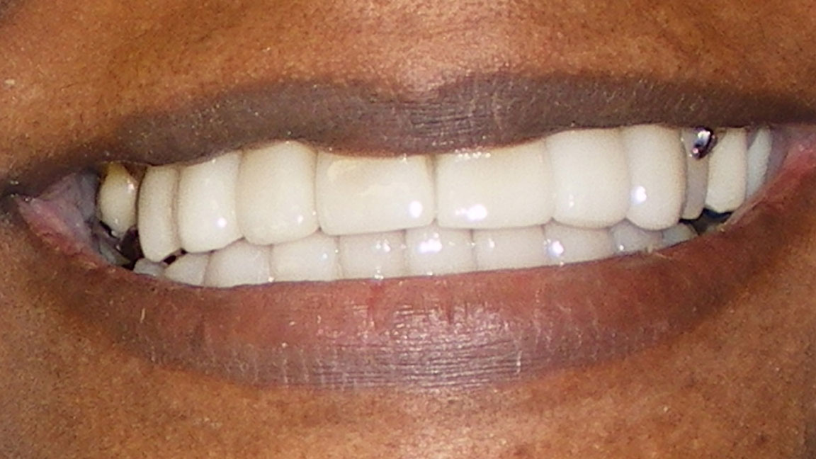 before and smile after photos at Nash Family Dentistry