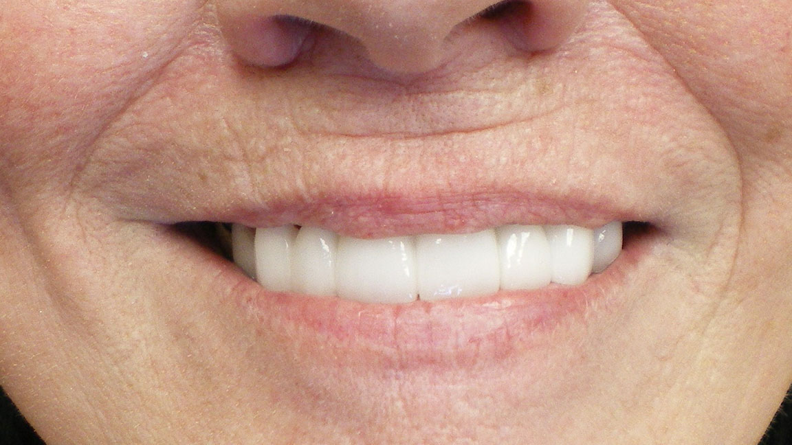 before and smile after photos at Nash Family Dentistry