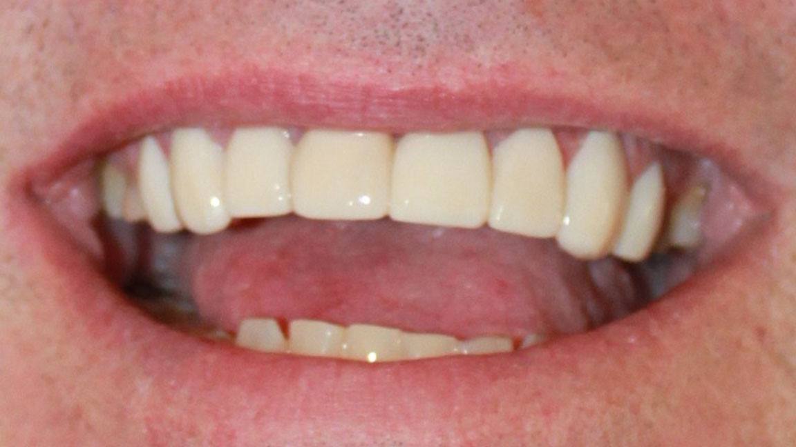 before and smile after photos at Nash Family Dentistry