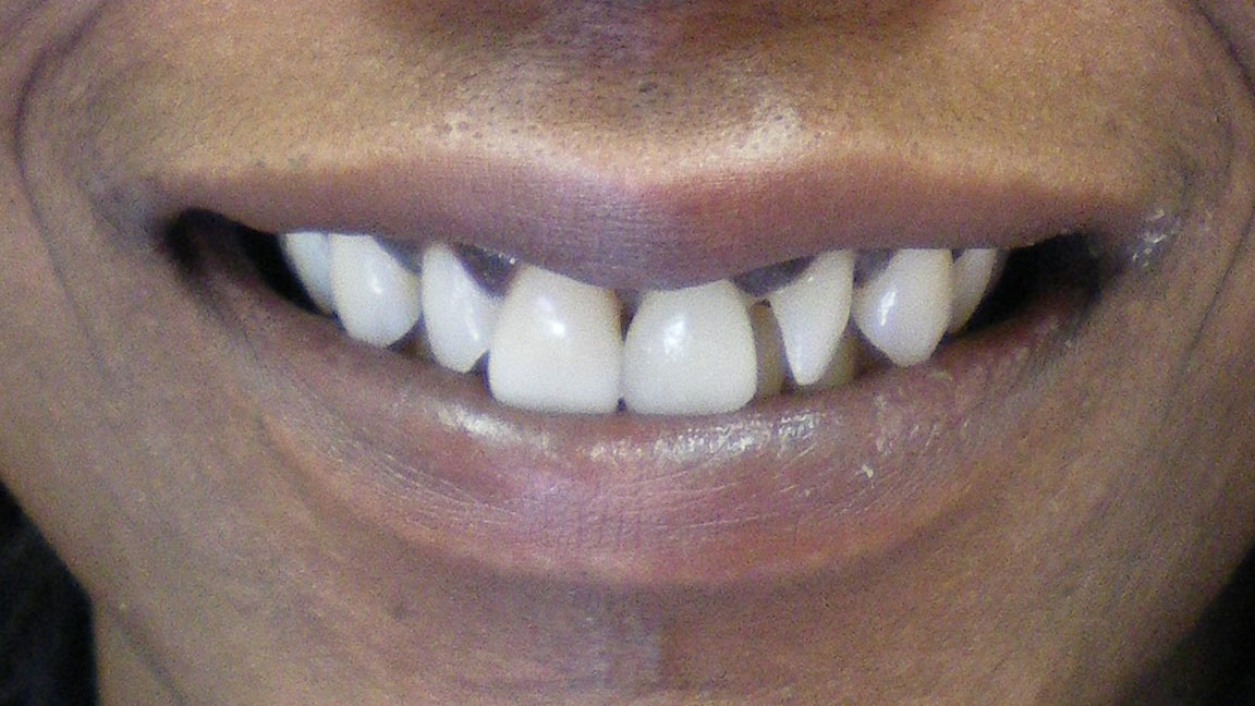 before and smile after photos at Nash Family Dentistry