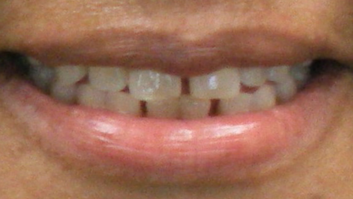 before and smile after photos at Nash Family Dentistry