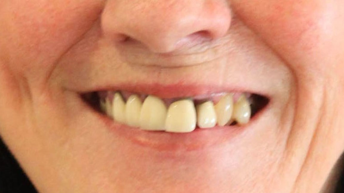 before and smile after photos at Nash Family Dentistry