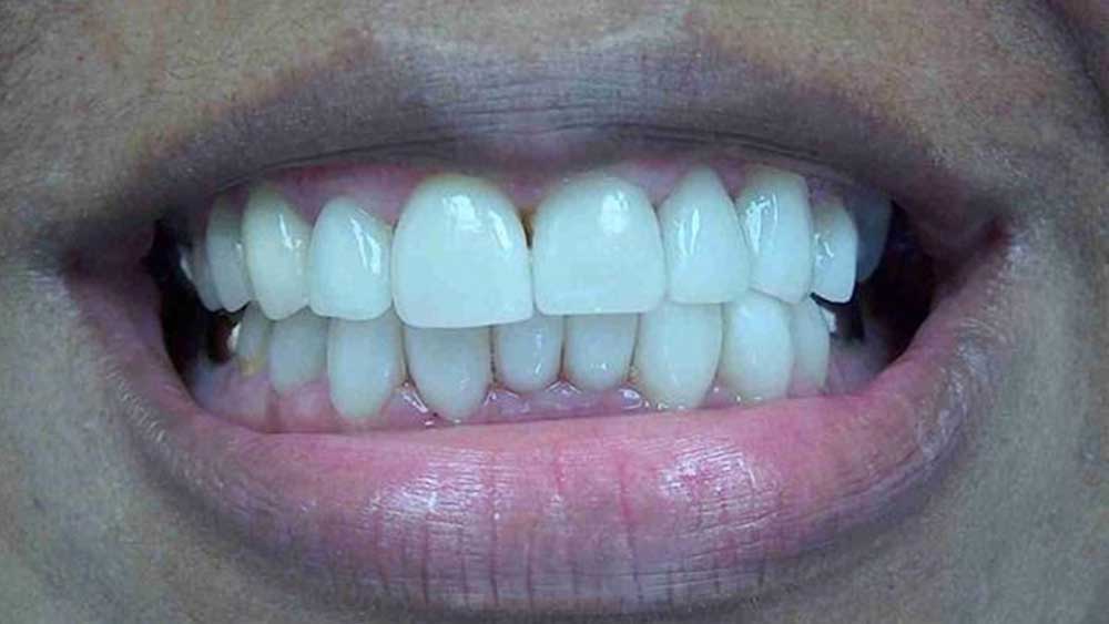 patient A's smile after the lumineer procedure