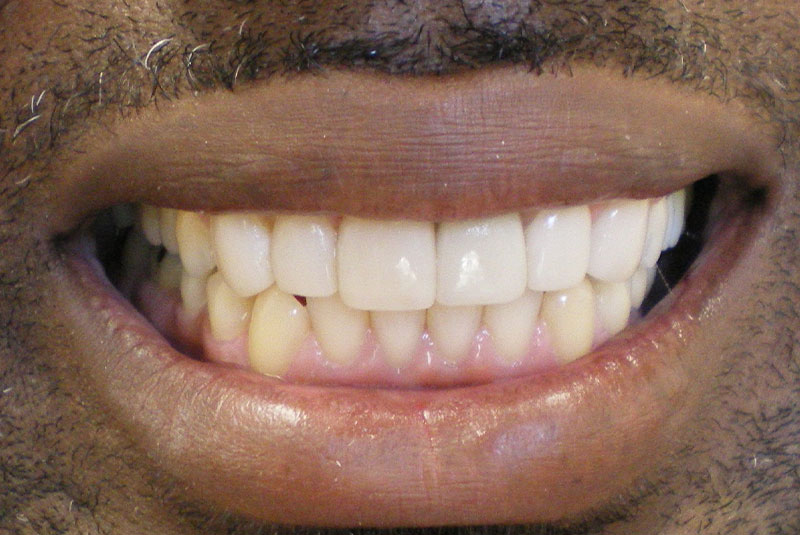 before and smile after photos at Nash Family Dentistry