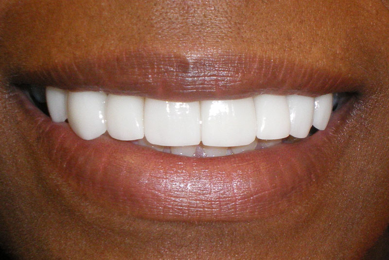 before and smile after photos at Nash Family Dentistry