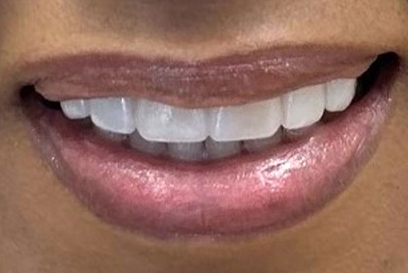 before and smile after photos at Nash Family Dentistry