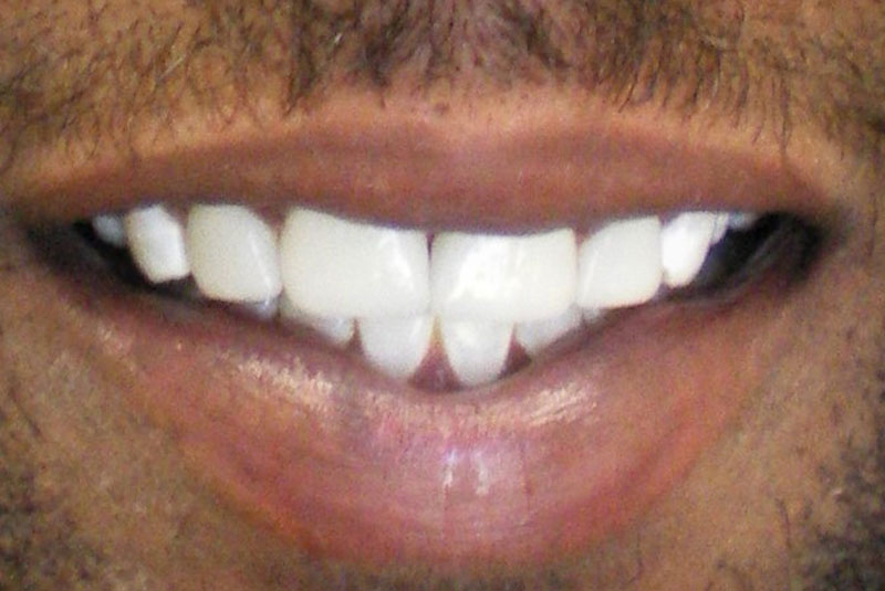 before and smile after photos at Nash Family Dentistry