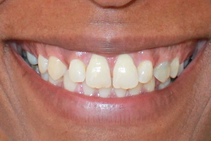 before and smile after photos at Nash Family Dentistry