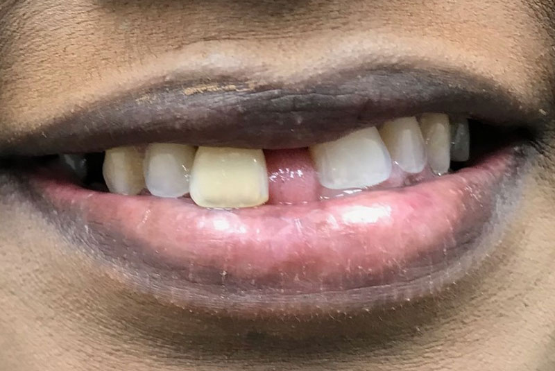 before and smile after photos at Nash Family Dentistry